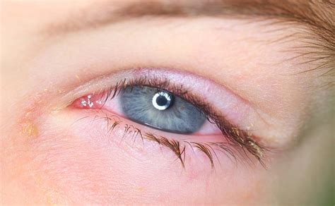 Bildergebnis für augenlidentzündung bilder