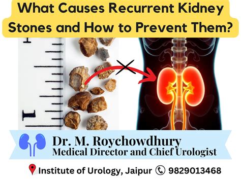 What Causes Kidney Stones Lithotripsy | Johns Hopkins Medicine