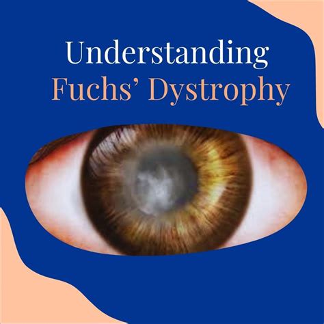 How Fuchs' dystrophy affects cornea | The Corneal Dystrophy Foundation posted on the topic ...