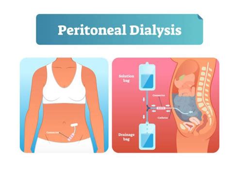 Kidney failure and its treatment options