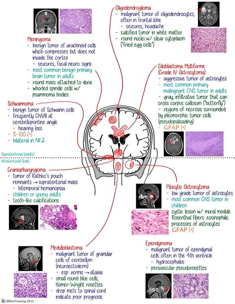 Brain Tumors - Cheat sheet