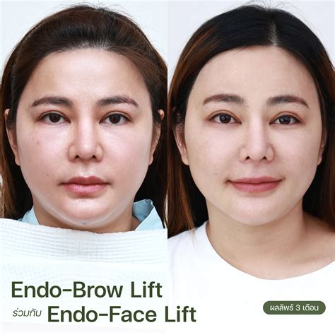 หมอบีม & หมอเอิร์ธ คว้ารางวัลเลิศ 'The Best Endoscopic Brow Lift