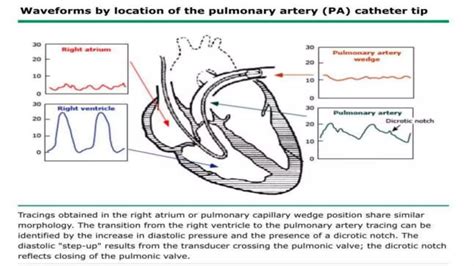 Pulmonary artery pressure monitoring | PPTX