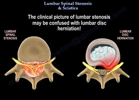 Lumbar Spinal Stenosis and Sciatica — OrthopaedicPrinciples.com