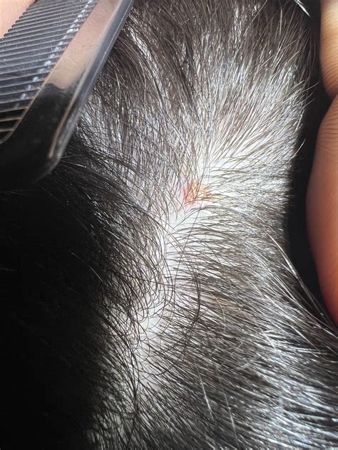 “Scab” that won’t heal in my scalp! : r/DermatologyQuestions