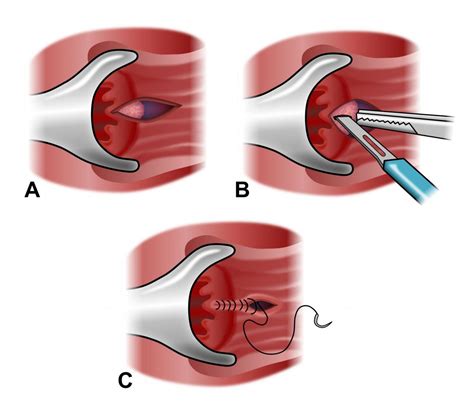 Anal fissure surgery (Sphincterotomy) - Khobragade Multispeciality Hospital