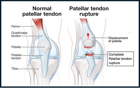 Ruptured Patellar Tendon - Knee Education