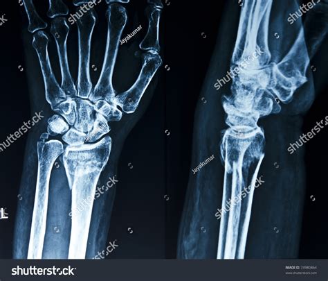 Broken X-Ray Wrist at Juliana Stclair blog