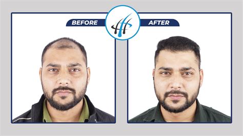 Best Hair Transplant Clinic in Allahabad/Prayagraj
