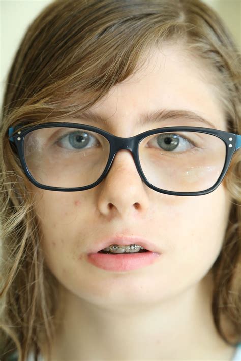 Para profesionales médicos: diagnóstico del síndrome de Moebius - Moebius Syndrome Foundation