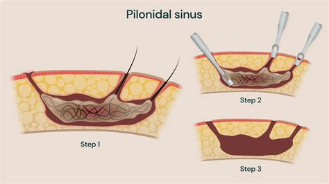 Pilonidal sinus: Symptoms and causes in adults and children