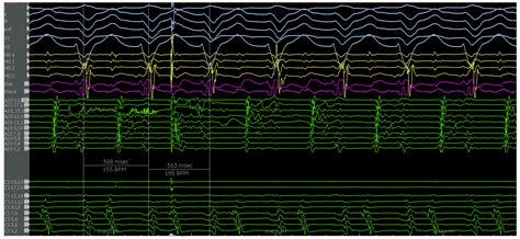 Electrophysiologic Considerations in Adult Patients with Ebstein’s Anomaly