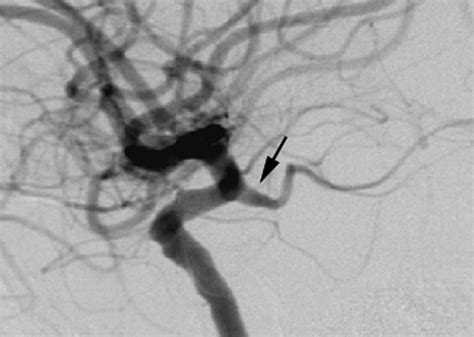 Dimpled Appearance of a Posterior Communicating Artery Saccule: An Angiographic Indicator of ...