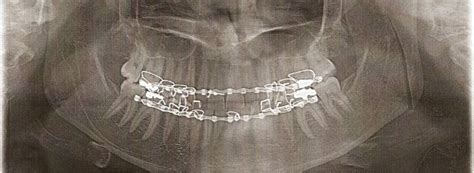 Tips on having your mouth wired shut | Jaw surgery, Liquid diet recipes ...