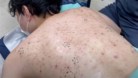 Image result for Back Full of Exploding Cysts