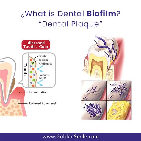 Dental Biofilm Formation at Pamela Walsh blog