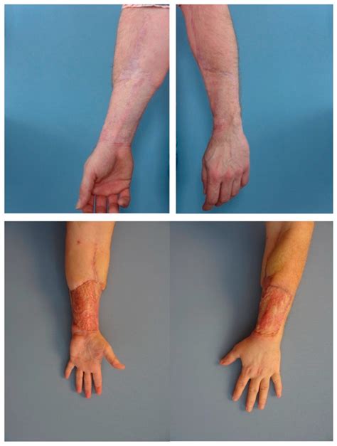 Phalloplasty After Recovery