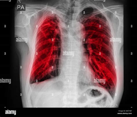 X Ray Chest Tuberculosis European Group Offers Guidance For Treating
