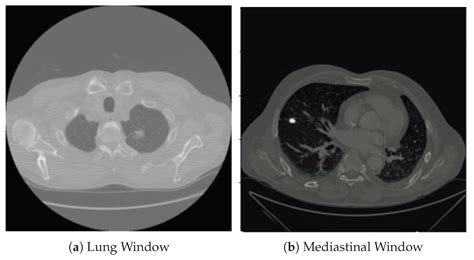 Optimal Thresholding for Multi-Window Computed Tomography (CT) to ...