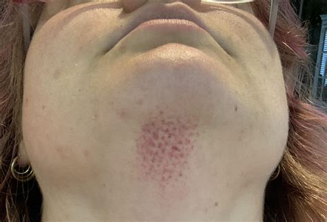 Rash with a sweater pattern under chin : r/DermatologyQuestions