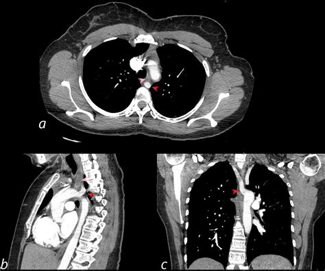 287Lu Aberrant Right Subclavian Artery and Dysphagia Lusoria | The ...