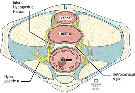 MRI Features of Pelvic Nerve Involvement in Endometriosis | RadioGraphics