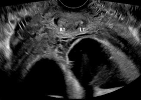 Didelphys Uterus Pregnancy Complications