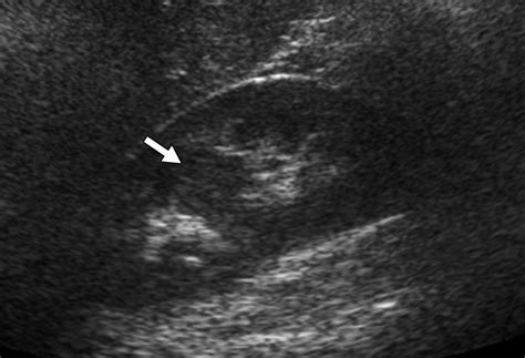 Focal Renal Lesions in Pediatric Patients | AJR