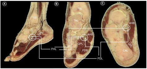 Dynamic Ultrasound Assessment and Guided Medial Plantar Nerve Hydrodissection for Master Knot of ...