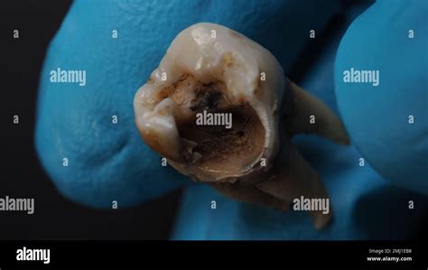 Decayed Tooth Pulling 的图像结果