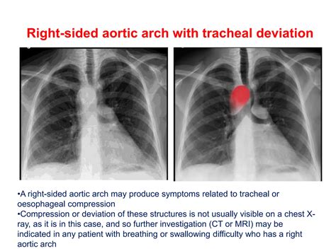 CHESTX-RAY ANATOMICAL VARIANTS......pptx