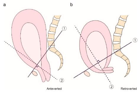 Horizontal Cervix as a Novel Sign for Predicting Adhesions on the ...