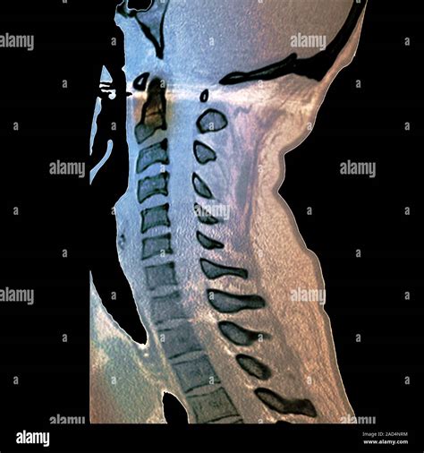 Slipped disc. Coloured computed tomography (CT) scan of a section through the cervical spine ...