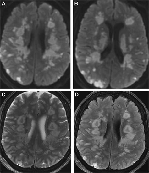 Toxic and Drug-Related White Matter Diseases of the Brain and Spine - Magnetic Resonance Imaging ...