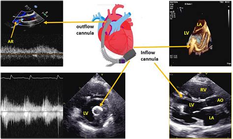 Frontiers | Reciprocal interferences of the left ventricular assist device and the aortic valve ...