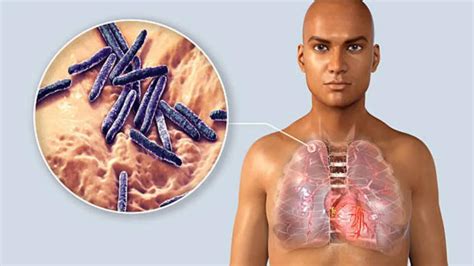 Monica Seles Opens Up On Her Diagnosis of Myasthenia Gravis, an ...