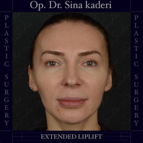 Extended Lip Lift: Eine dauerhafte Technik für ein harmonisches Gesicht ...