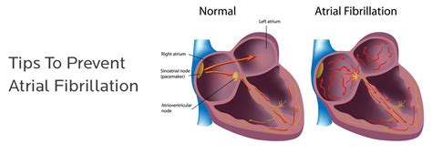 Atrial Fibrillation 的图像结果