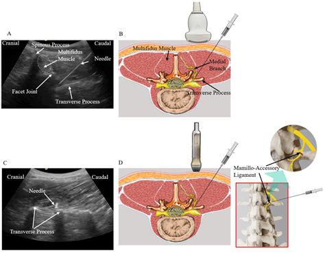Determining the Most Suitable Ultrasound-Guided Injection Technique in Treating Lumbar Facet ...