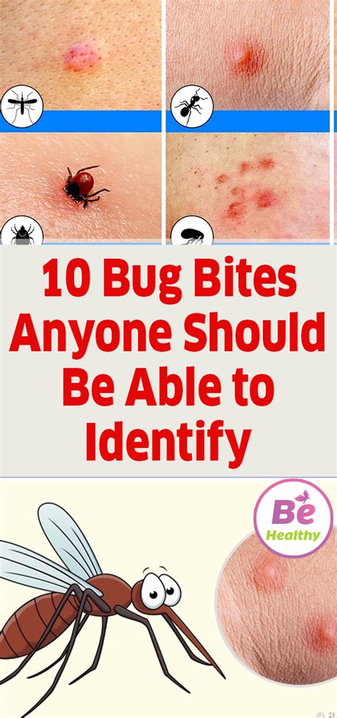 Image result for Bug Bite Identification Chart