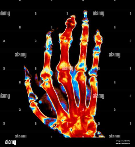 Gouty hand. Coloured X-ray image of the hand of a patient suffering from gout and associated ...