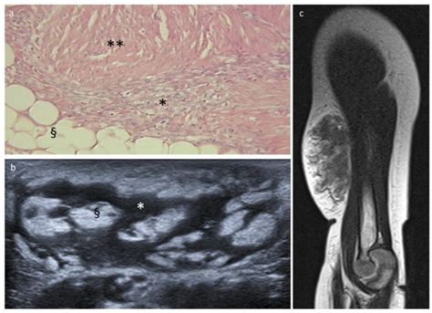 Fat-Containing Soft Tissue Tumors in Children, Adolescents, and Young ...