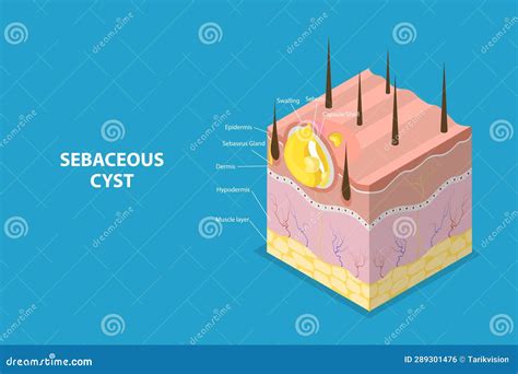 Image result for Sebaceous Cyst On Back