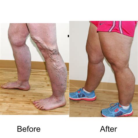 Varicose Vein Treatments | Madison Medispa, Waunakee