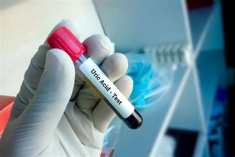 Uric Acid Test: Procedure , Purpose, Normal Range