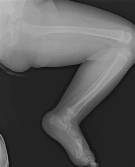 An Updated Approach to Toddler Fractures | Journal of Urgent Care Medicine