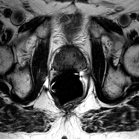 Multiparametric MR Imaging of the Prostate after Treatment of Prostate ...