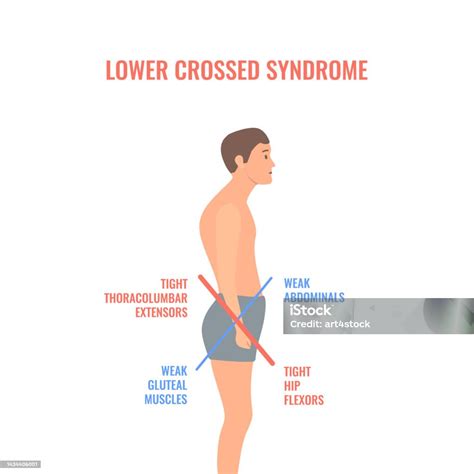 Crooked Man With Lower Crossed Syndrome Imbalance Stock Illustration ...