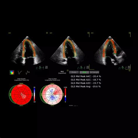 EPIQ ultrasound machines - Philips