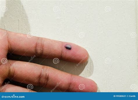 Bruise in finger stock image. Image of injure, bruise - 99580631